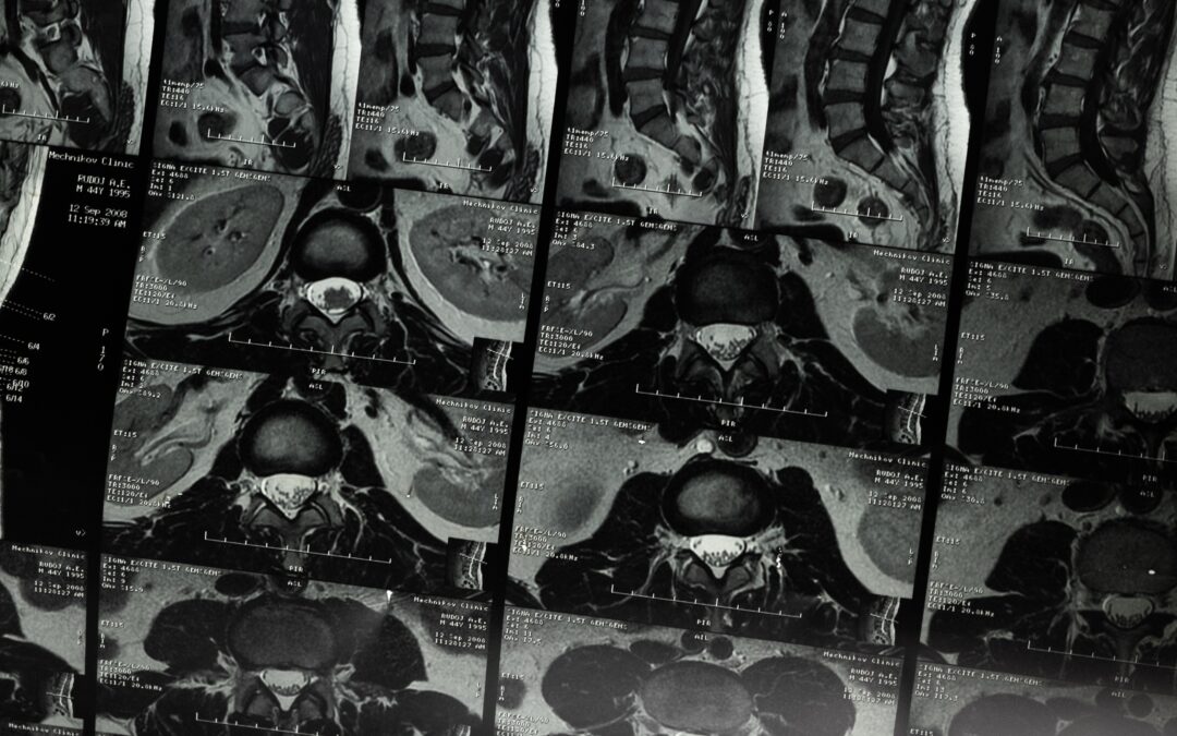 Lumbar MRI
